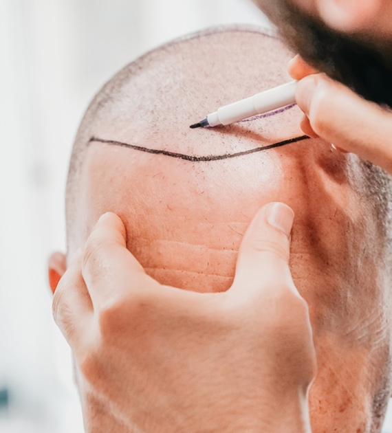 Gynecomastia Consultation Image